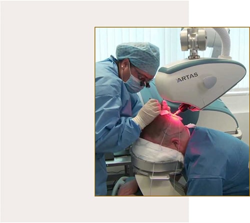 کاشت مو به روش SUT hair transplantation کاشت مو به روش SUT hair transplantation